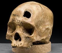 Photo By Frontal bone - Wikipedia, the free encyclopedia